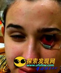 隐形眼镜藏变形虫 少女眼角膜被蚕食险失明