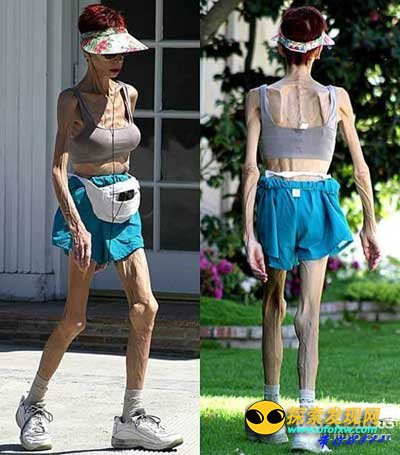 世界上最瘦的女人