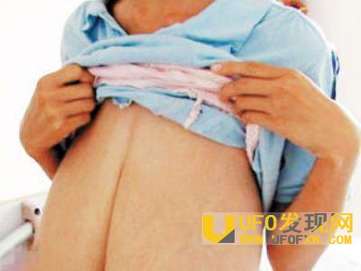 女童患巨乳症照片
