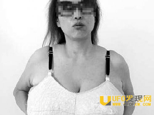 女童患巨乳症照片