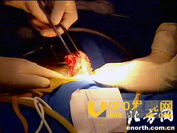 人体肛门能塞多大东西