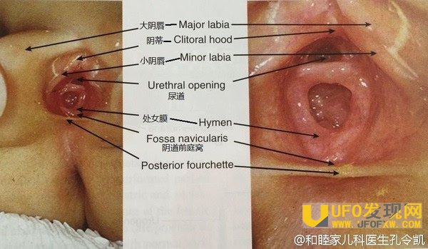 小阴唇跟大阴唇粘连图