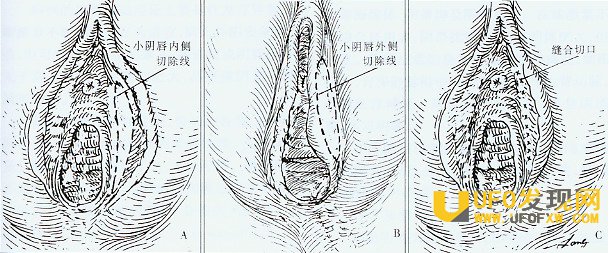 小阴唇跟大阴唇粘连图