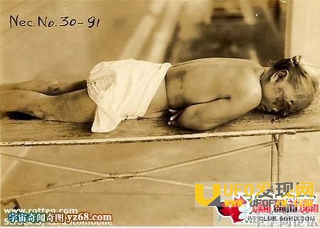 在女性身上试验梅毒资料图