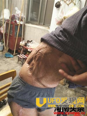 男子捡到宝贝终生残疾
