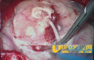 男子身体里竟拔出这物