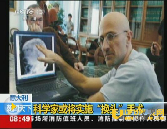 世界首例换头手术